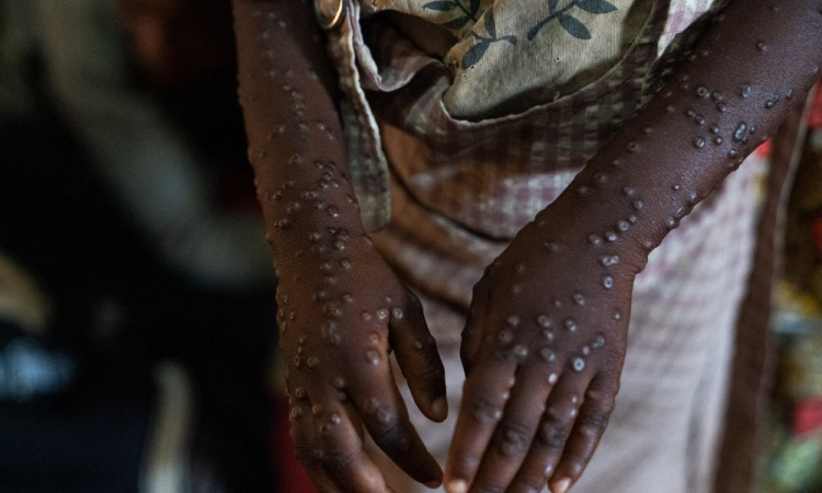 Mpox em alta: Brasil se aproxima da marca de 90 casos confirmados